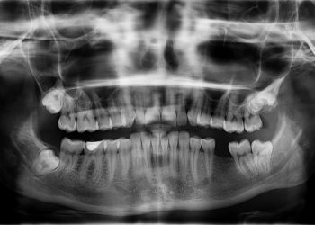 Cat de sigure sunt radiografiile dentare