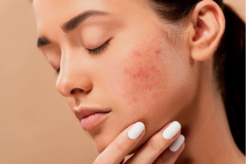 ce alimente provoaca acnee - sfatulparintilor.ro - pixabay_com - acne-5561750_1920