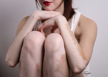 ce este vitiligo