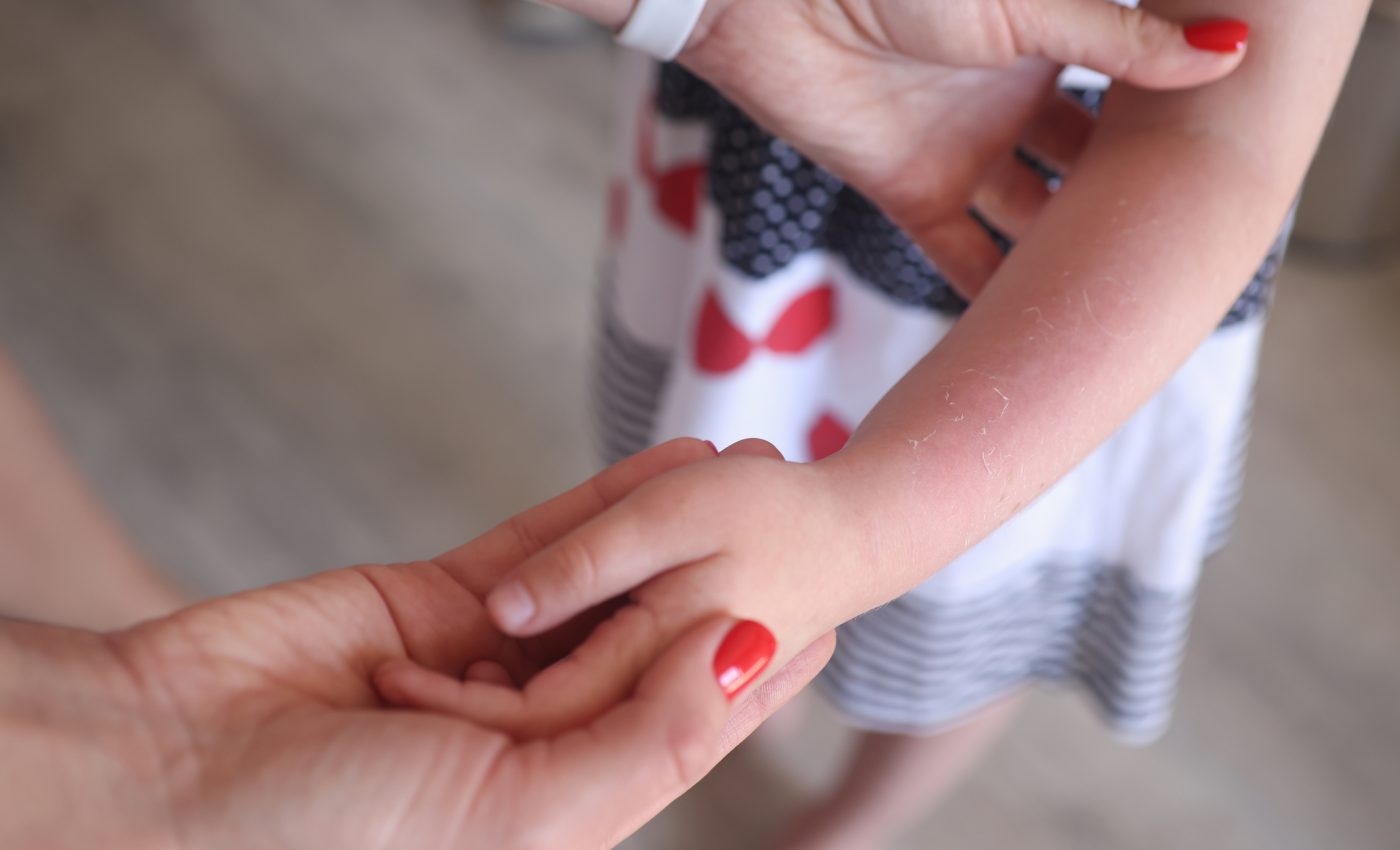 remedii eczeme copii