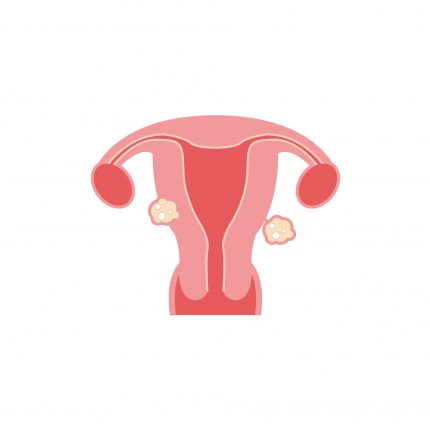 fibrom uterin - sfatulparintilor.ro - pixabay_com - fibroids-2947710_1920