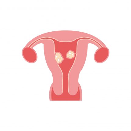 fibrom uterin - sfatulparintilor.ro - pixabay_com - fibroids-2947712_1920