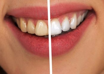 Metode naturiste de albire a dinților