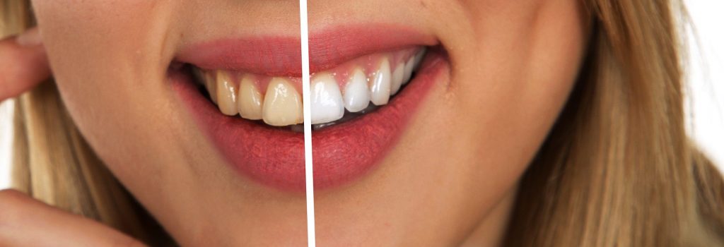 Este sigură albirea dinților acasă - sfatulparintilor.ro - pixabay_com - tooth-2414909_1920