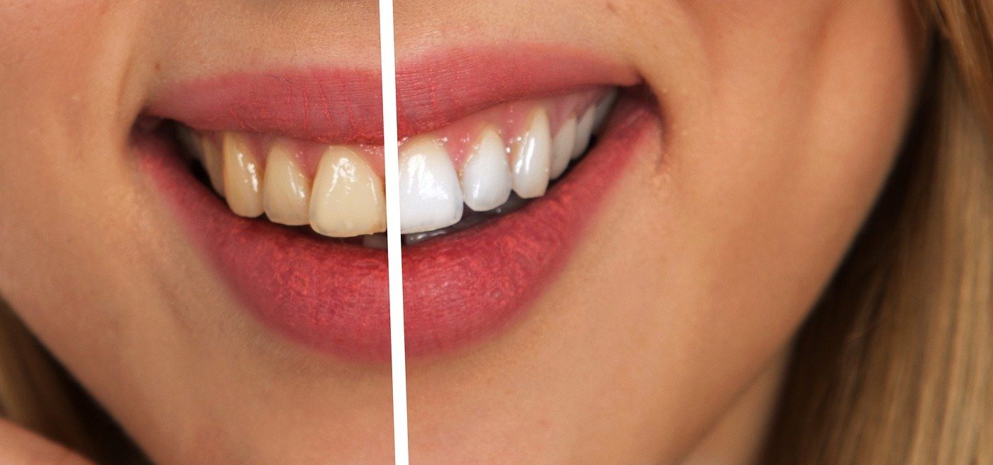 Este sigură albirea dinților acasă - sfatulparintilor.ro - pixabay_com - tooth-2414909_1920