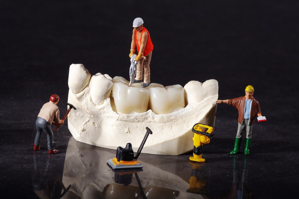 Implant sau punte dentară - sfatulparintilor.ro - Depositphotos_36813819_L
