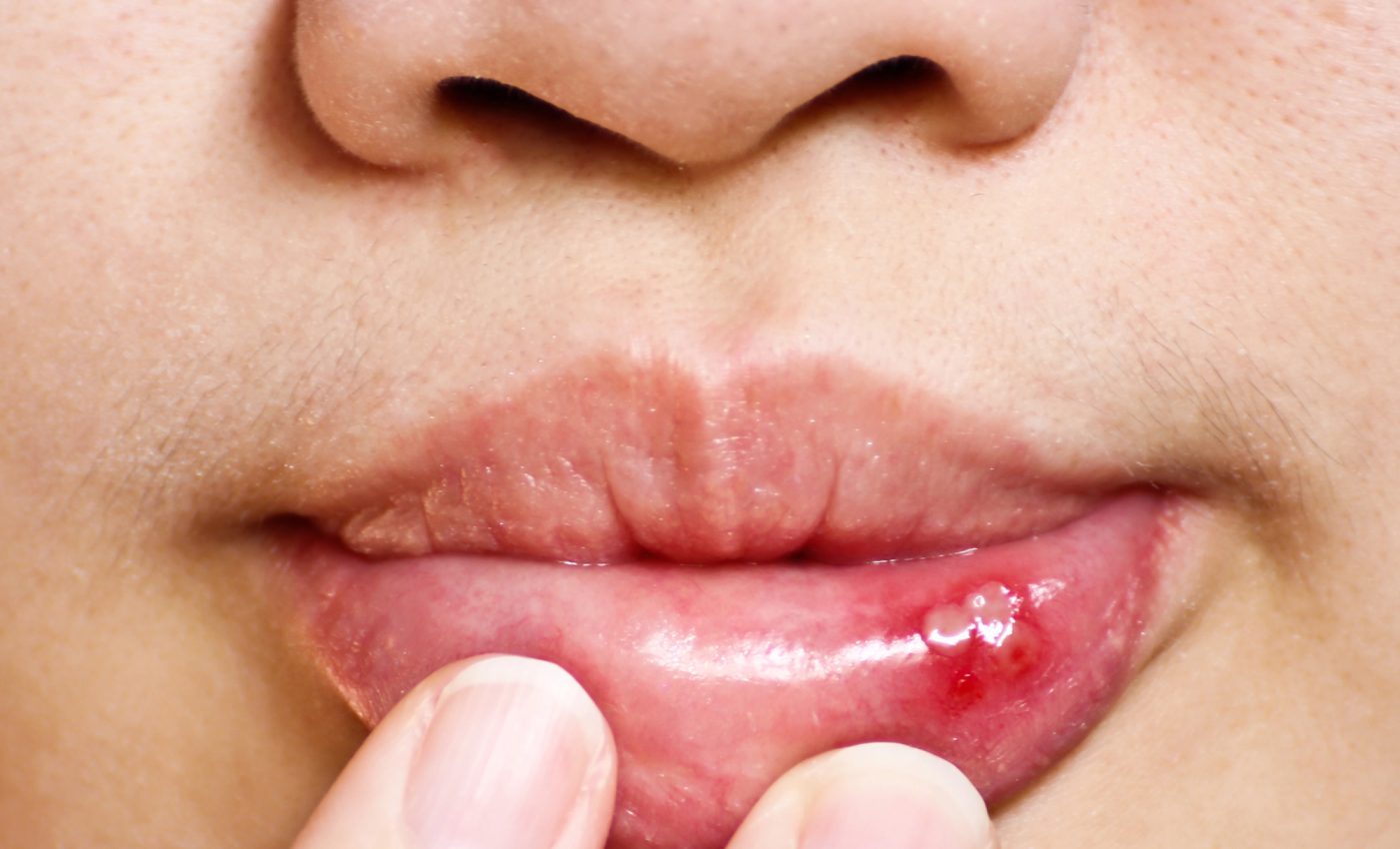 De ce apar aftele bucale