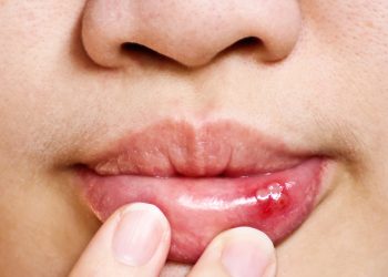 De ce apar aftele bucale